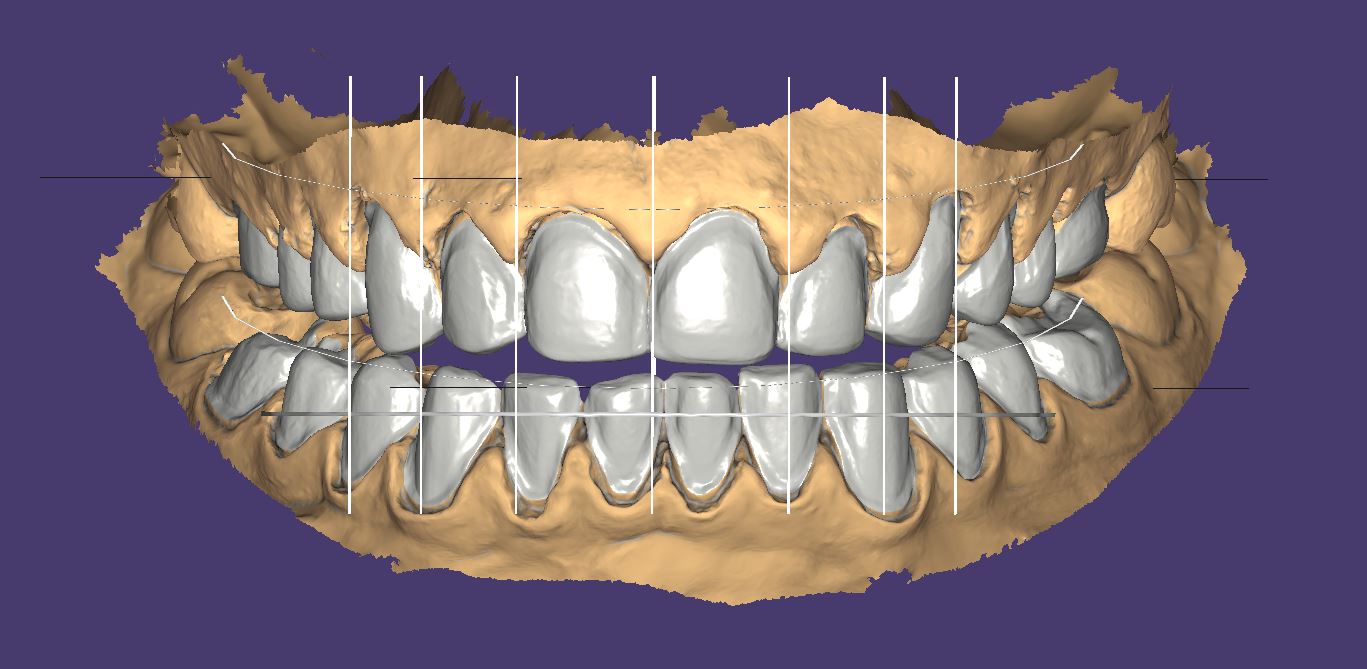 L'impression 3d dentaire au service de la dentististerie - CFAO